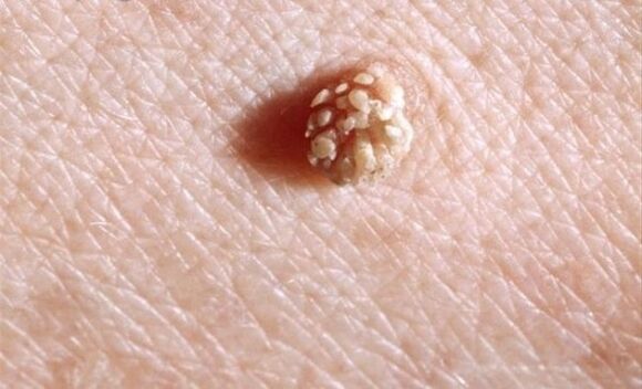 Papiloma ant žmogaus kūno
